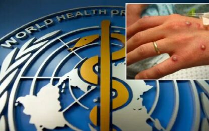 Alerta internacional: OMS confirma 80 casos de viruela del mono